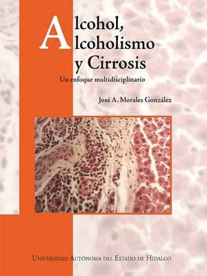 cover image of Alcohol, alcoholismo y Cirrosis